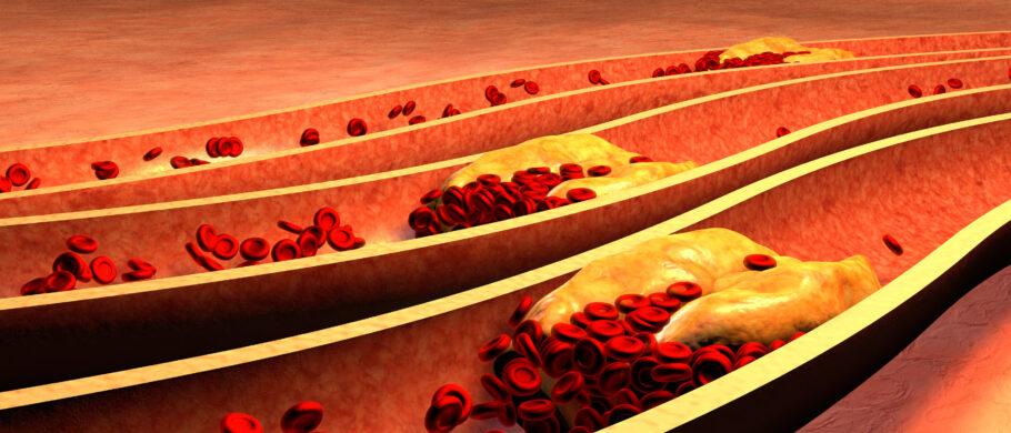 A hipercolesterolemia familiar é responsável por níveis elevados de colesterol desde a infância