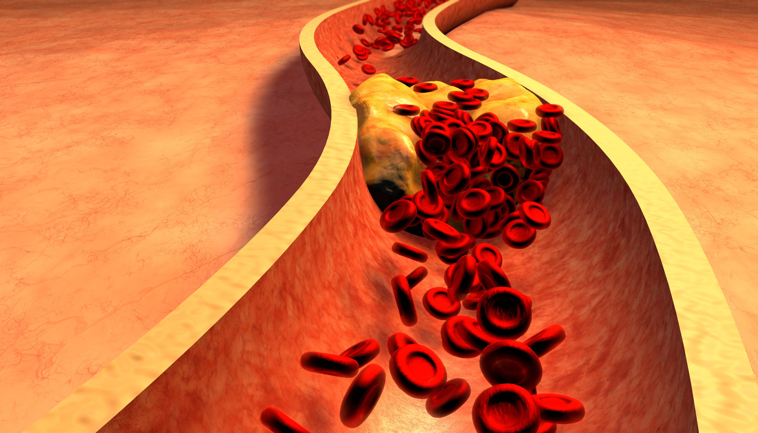 Veja o que pode ajudar a controlar o colesterol ruim