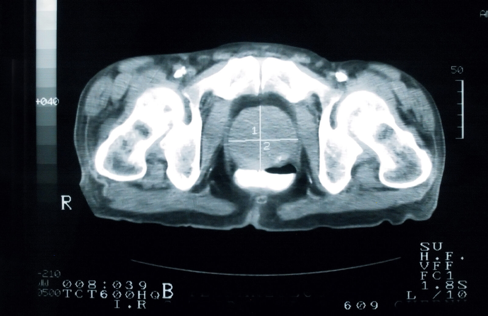 Sintomas do câncer de próstata para se atentar