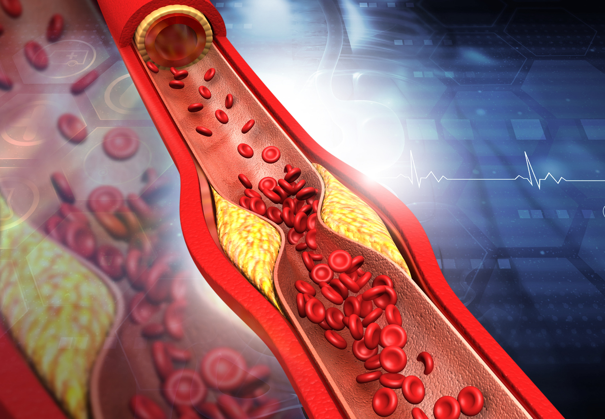 Formas de reduzir o colesterol ruim e evitar doenças crônicas