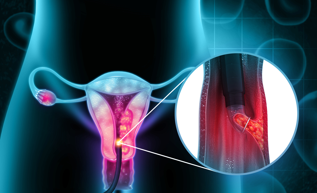 Veja os sintomas do câncer de colo de útero