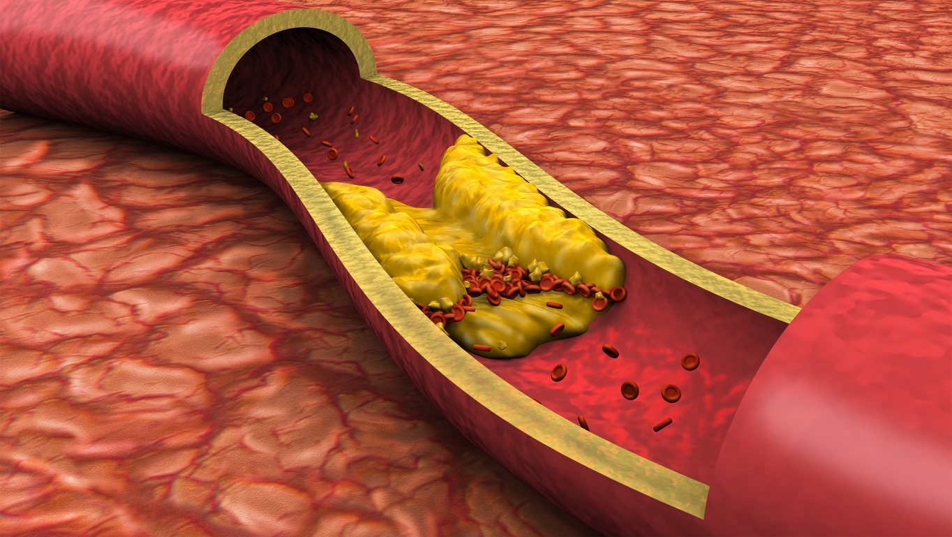 Doença genética: Tratamento envolve medicamentos para reduzir o colesterol e outras estratégias para gerenciar o risco cardiovascular – iStock/Getty Images