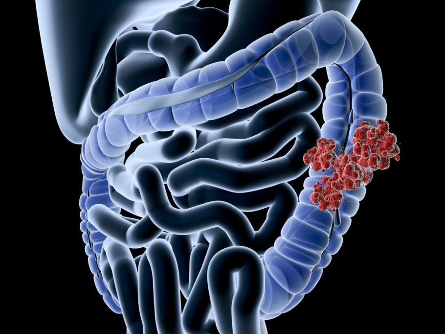 Conheça os sinais de câncer de intestino