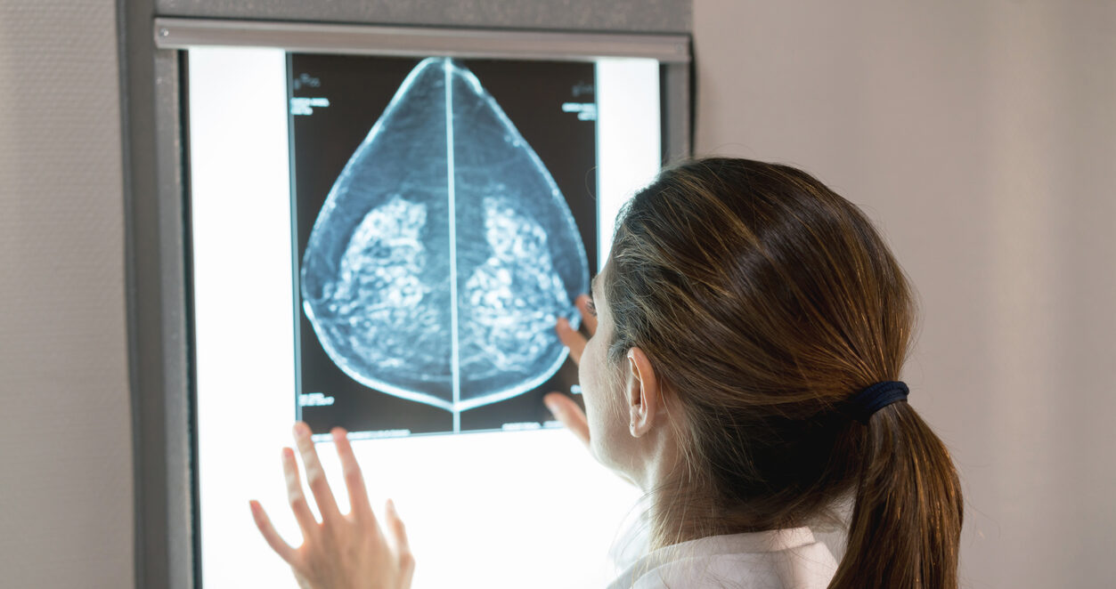 O que aumenta as chances de desenvolver câncer de mama?