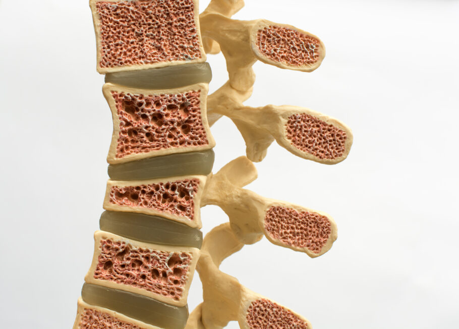 A osteoporose é uma doença progressiva e silenciosa