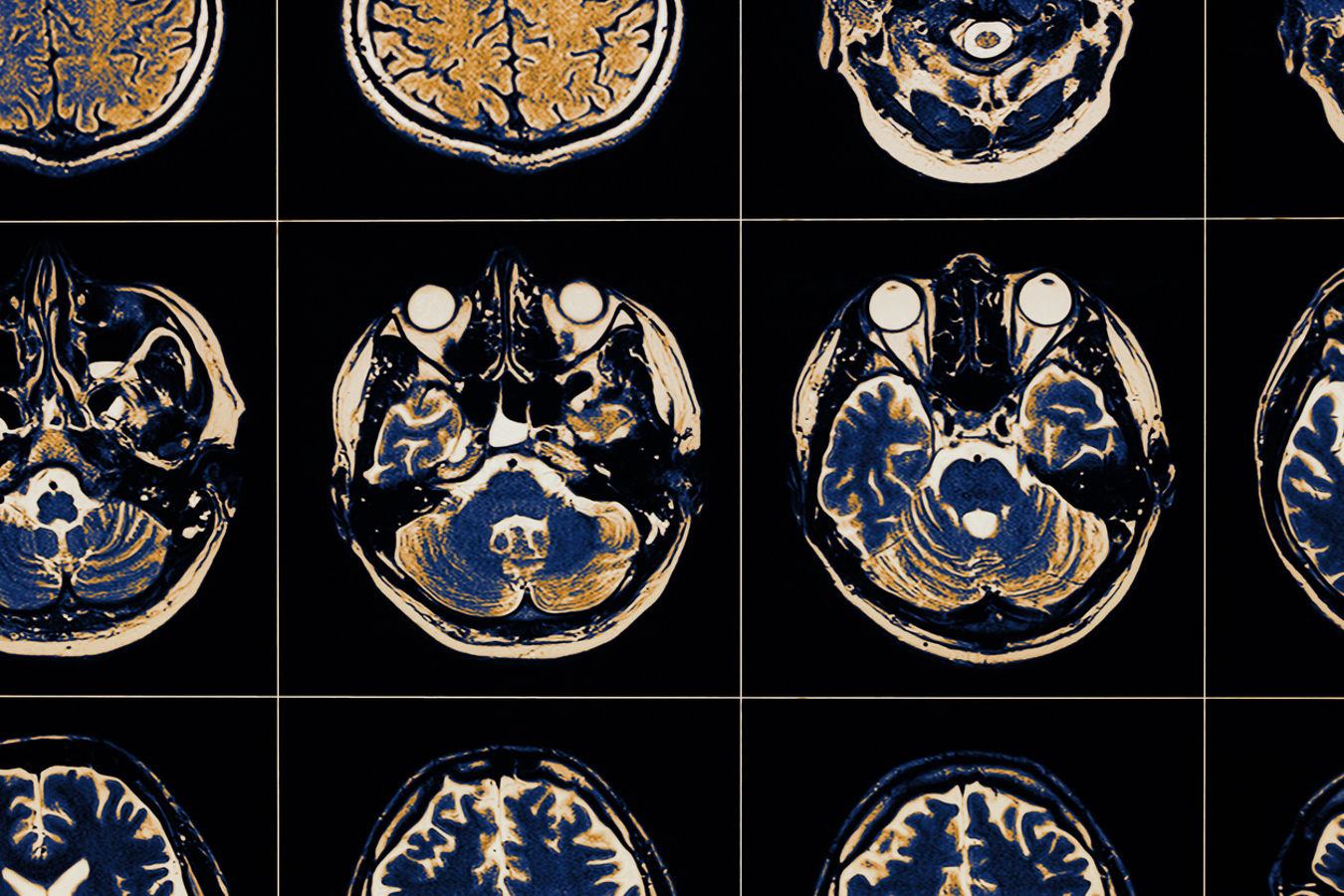 Inteligência artificial na detecção precoce do Alzheimer