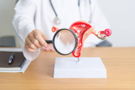 Endometriose é uma enfermidade que ocorre quando o endométrio, tecido que reveste o útero internamente, surge em regiões externas ao útero