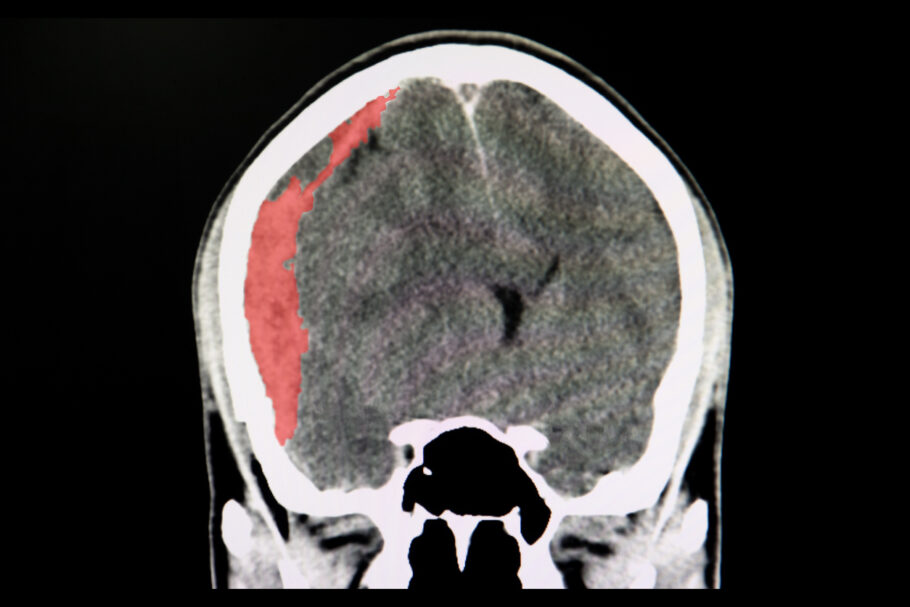Hematoma subdural agudo é uma forma de sangramento cerebral