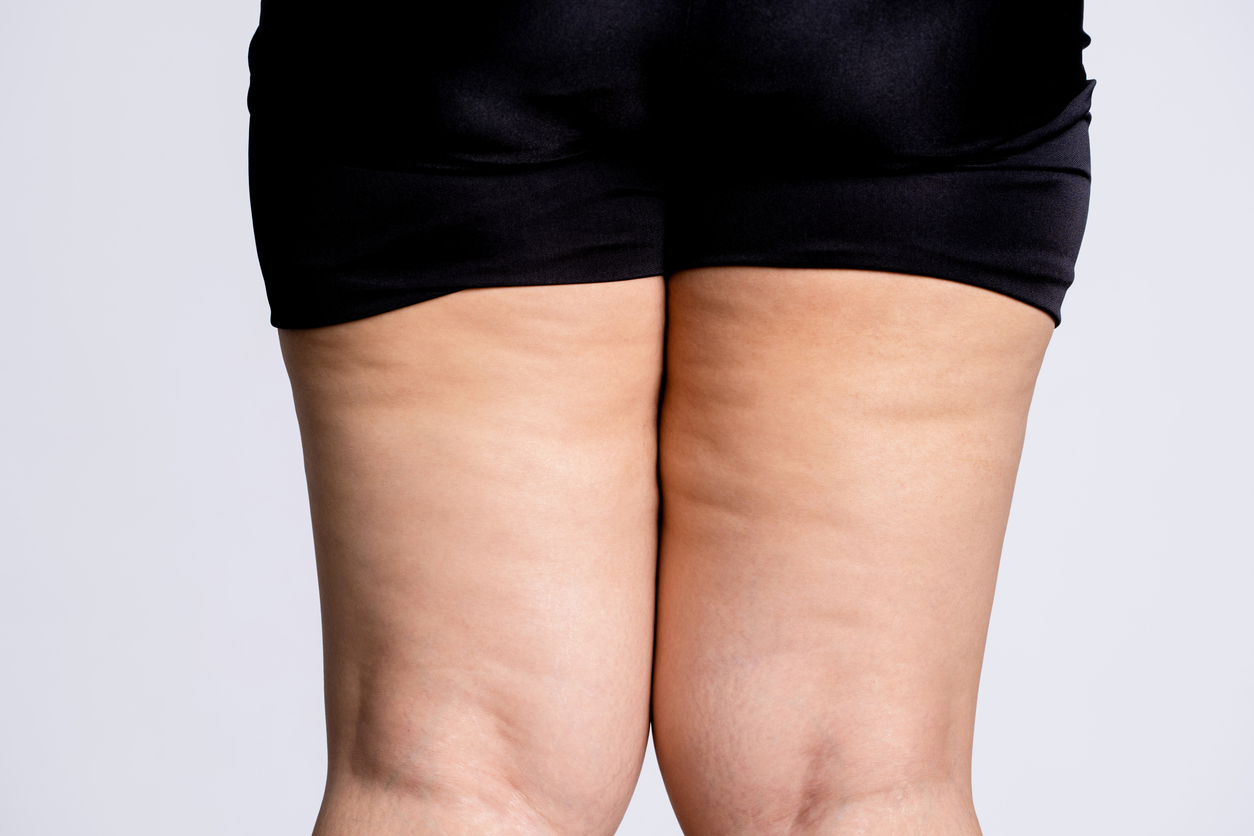 Lipedema é frequentemente confundido com outras condições