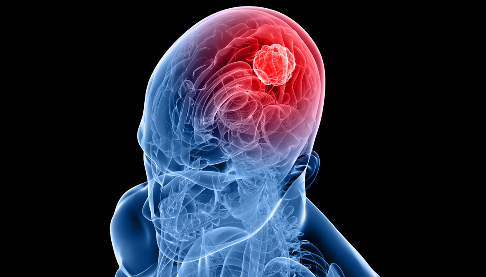 Os sintomas e fatores de risco do câncer de cérebro