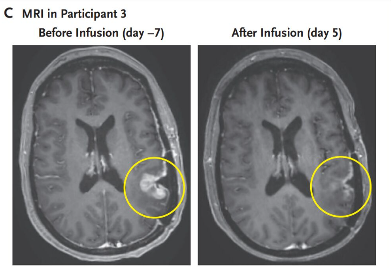 Imagens mostram tumor antes e após o tratamento