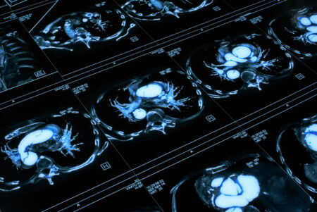 Sintoma do aneurisma cerebral