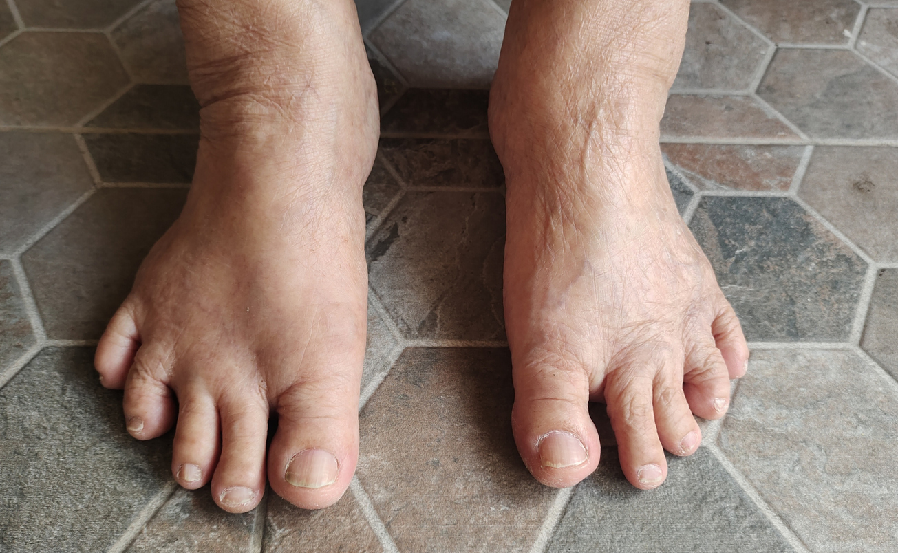 Os pés inchados podem indicar doença no fígado
