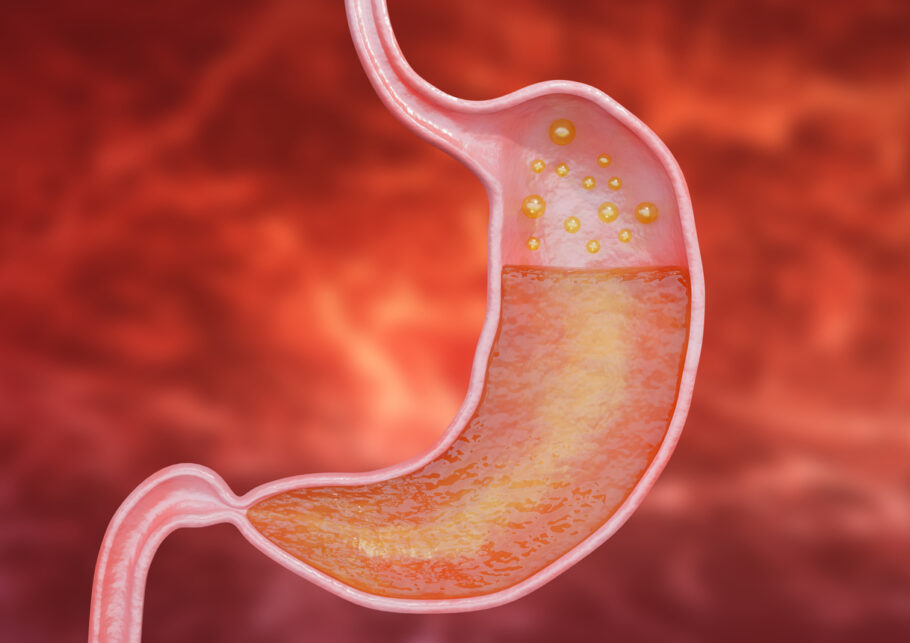 Gastrite é inflamação da mucosa do estômago