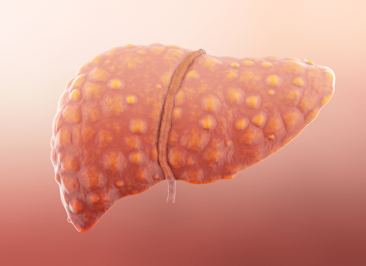 A representação de um fígado com gordura