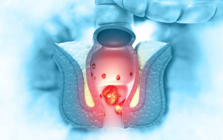 Hemorroidas são protuberâncias que se formam devido ao aumento dos vasos sanguíneos; veja alimentos para evitar