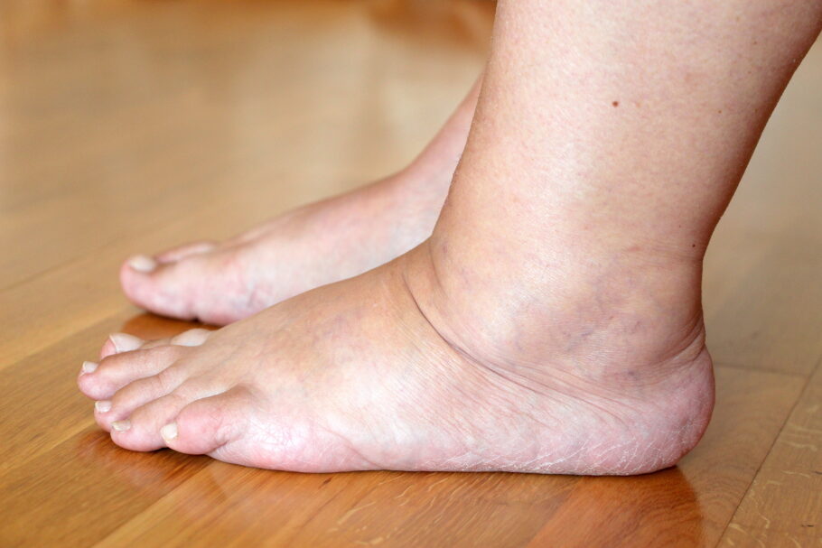 Inchaço nos pés e tornozelos pode indicar doença hepática gordurosa