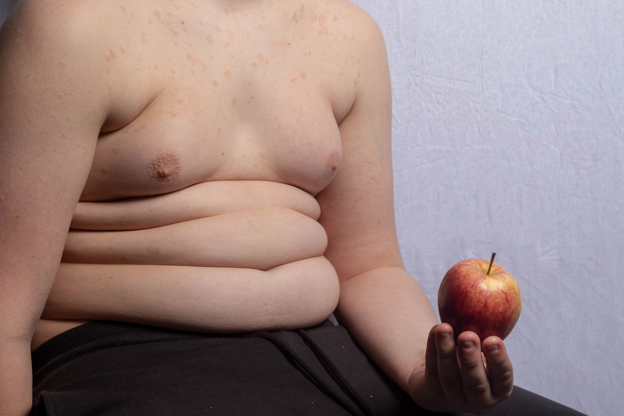 Criança obesa segurando uma maçã
