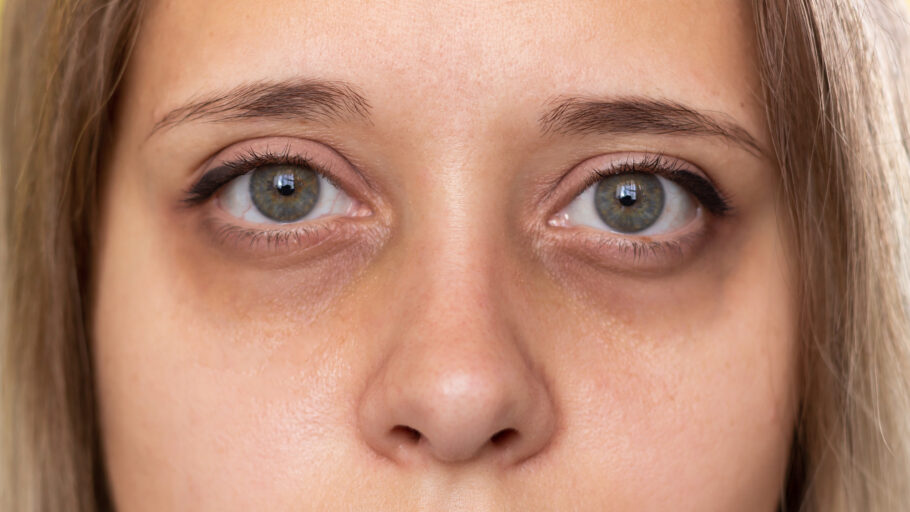 Vários problemas de saúde podem intensificar as olheiras