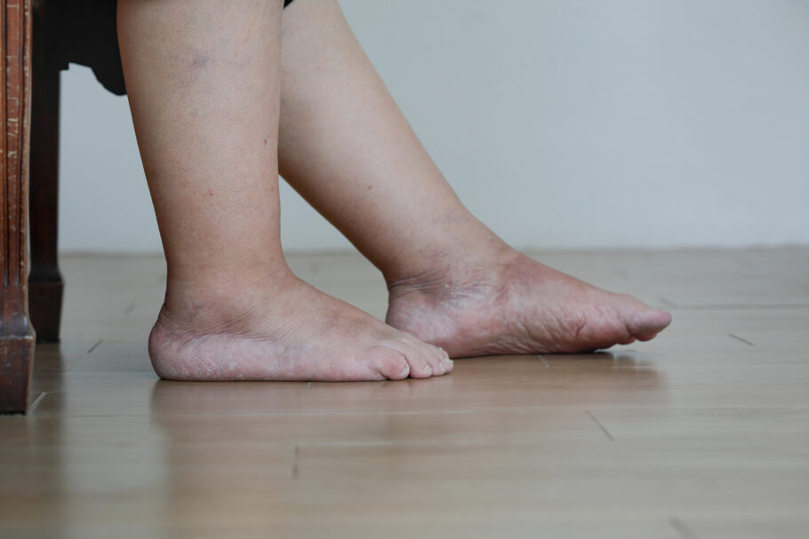 Pernas inchadas podem indicar problema grave de saúde