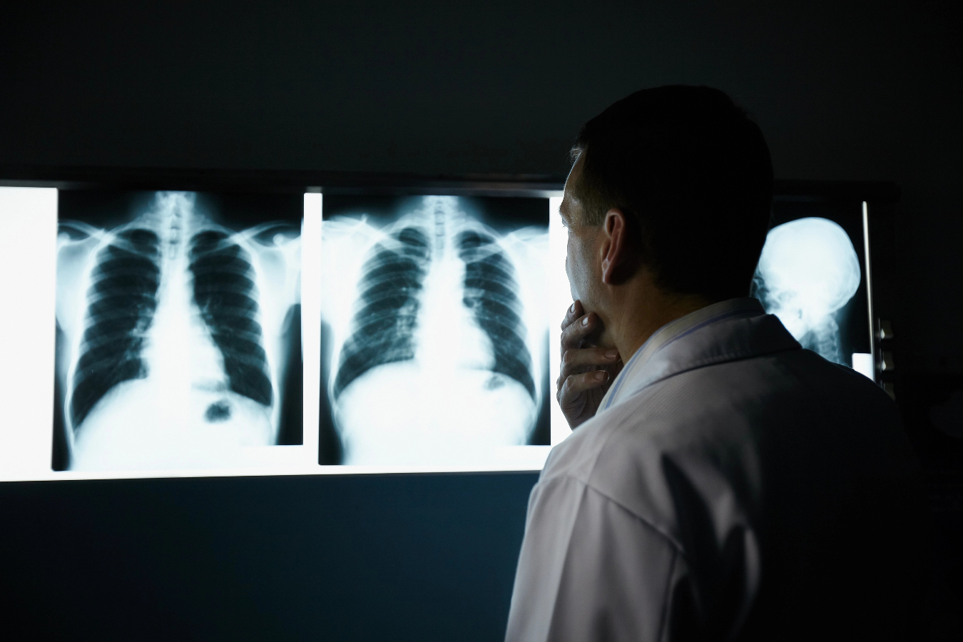 Entendendo os riscos de câncer de pulmão em quem nunca fumou