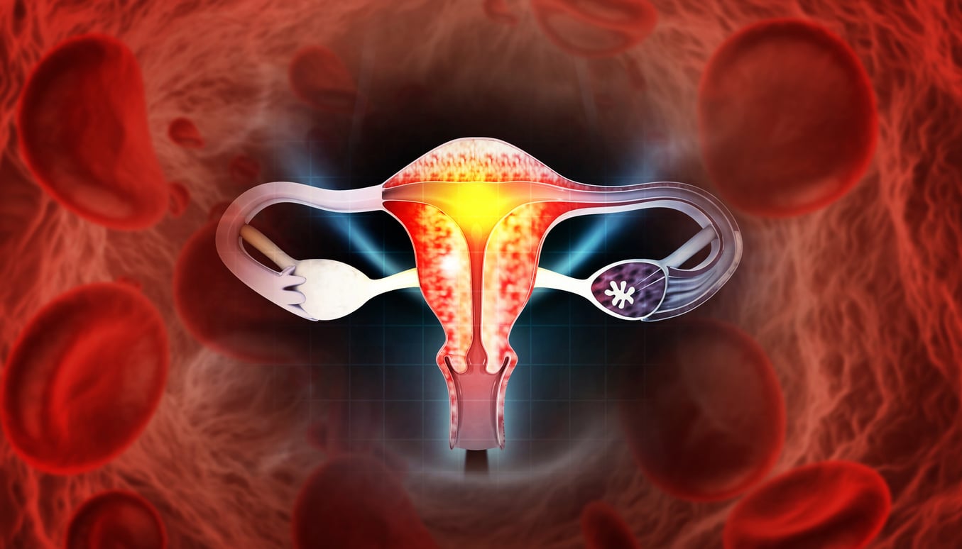 Síndrome dos ovários policísticos