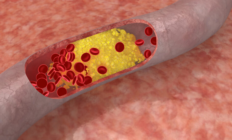 O colesterol alto pode ter inúmeras consequências para a saúde