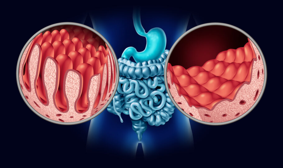 A doença celíaca pode causar danos ao intestino delgado