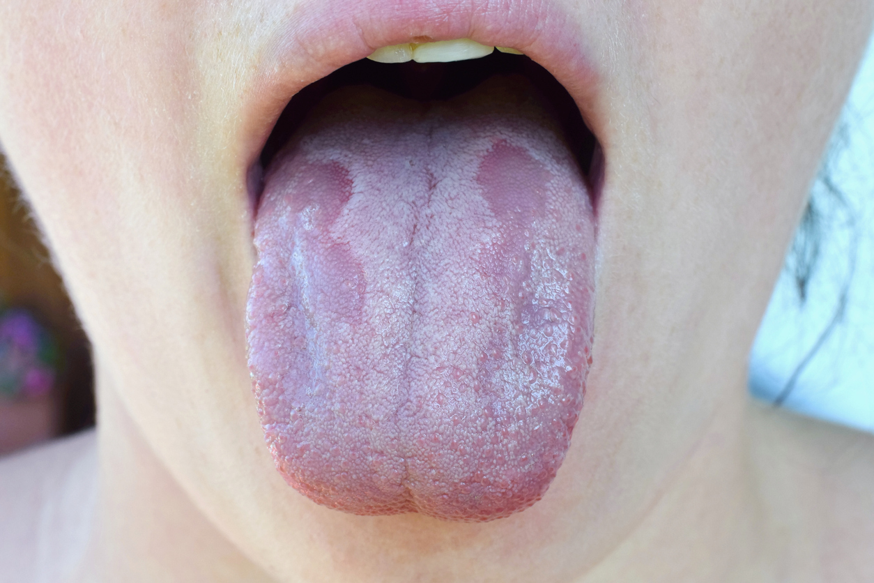 Causas e tratamentos para a língua branca