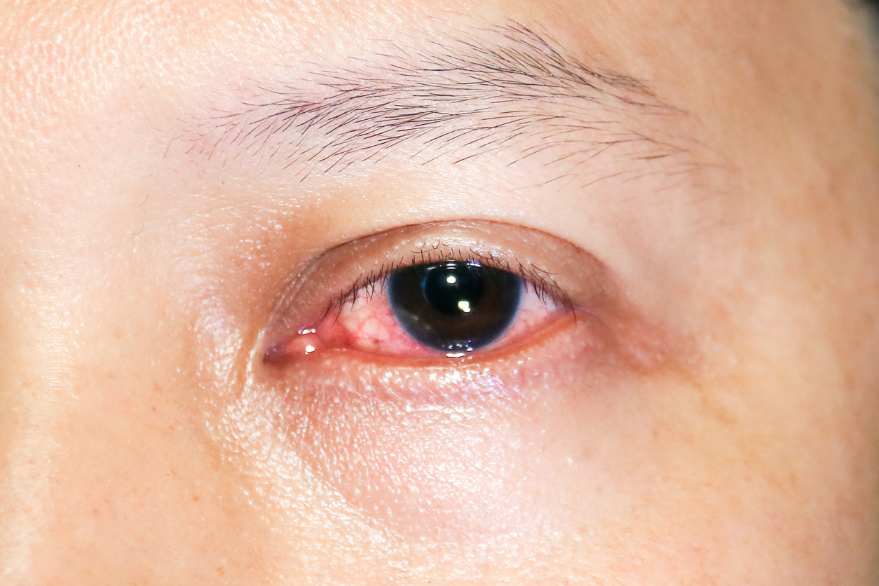Melanoma ocular: nova técnica promete revolucionar tratamento