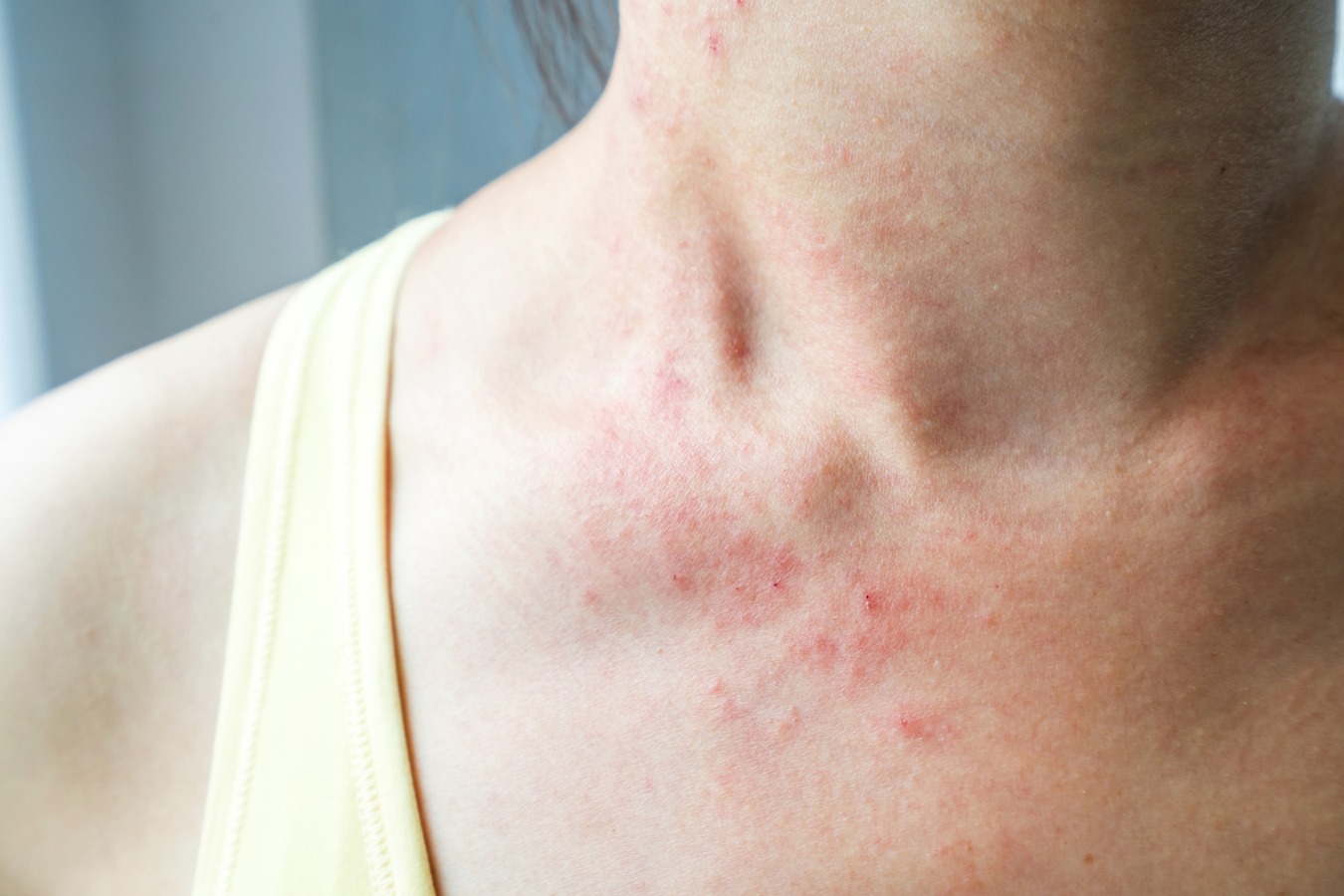 Prurido na pele, um sintoma presente em cerca de 75% dos casos