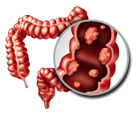 Vitamina B9 para câncer de intestino