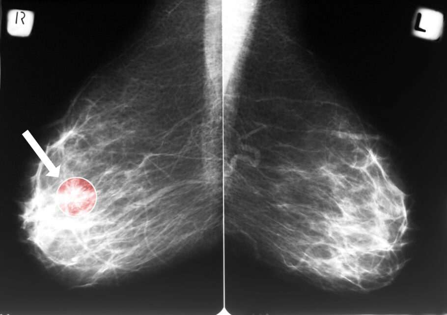 Os fatores de risco do câncer de mama envolvem estilo de vida e genética