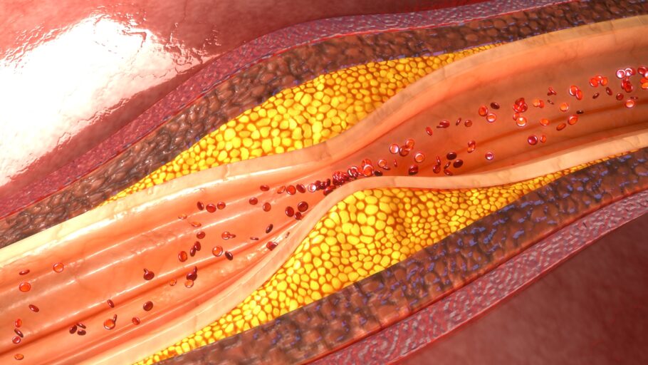 O colesterol sem controle pode causar uma série de complicações à saúde