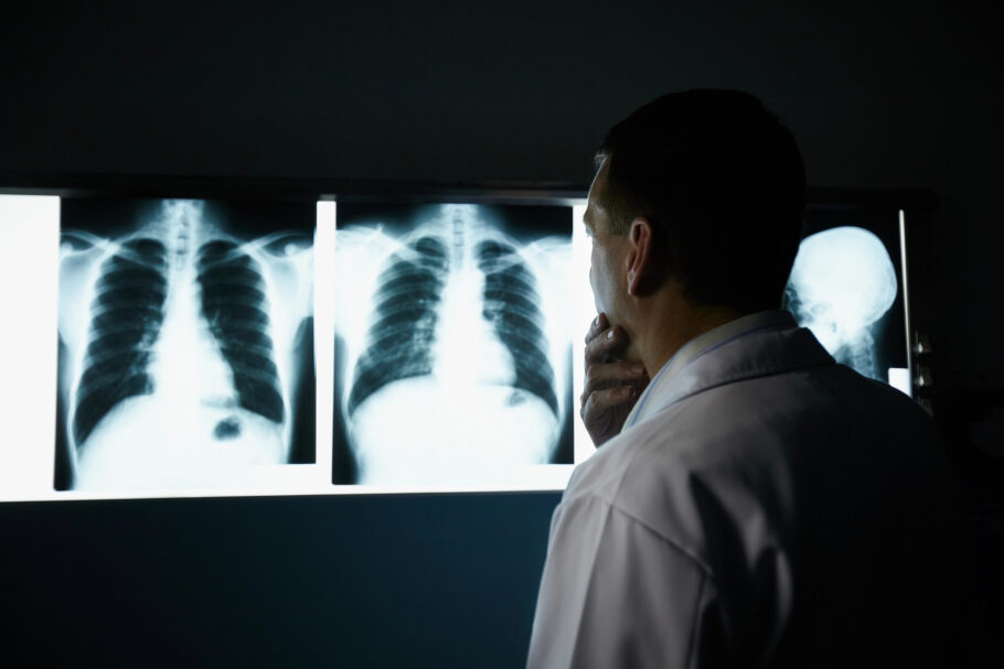 Medicamento evita progressão do câncer de pulmão em 60% dos casos em ensaio