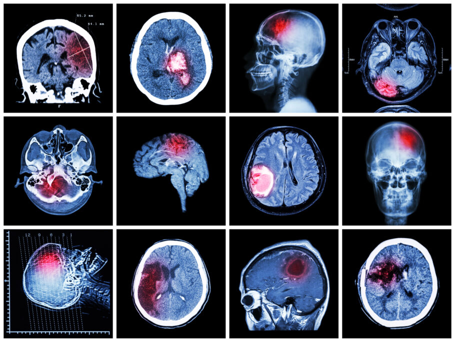 Conheça os tipos e sintomas de tumor cerebral