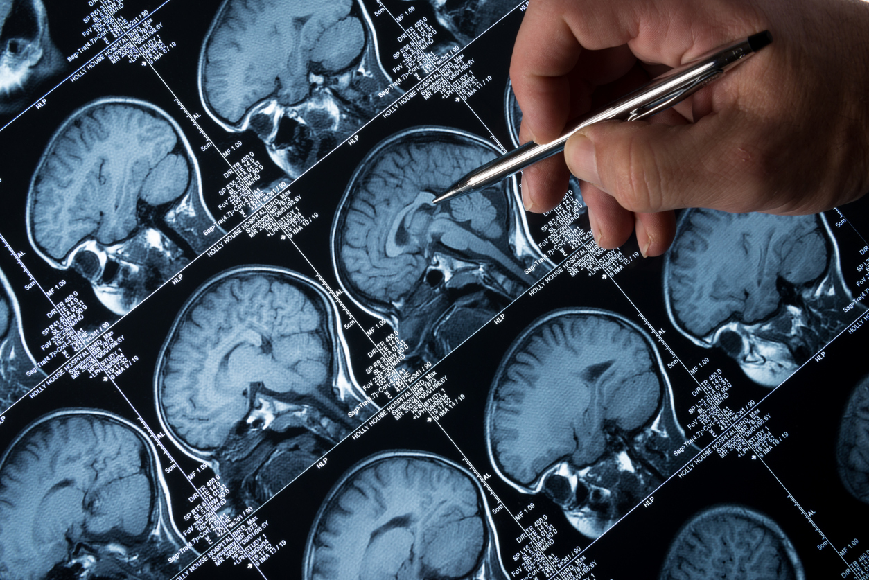Primeiro sintoma do Alzheimer é identificado décadas antes