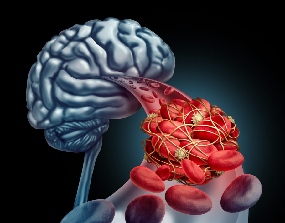 AVC ocorre quando ocorre a interrupção ou redução do fluxo sanguíneo para uma parte do cérebro