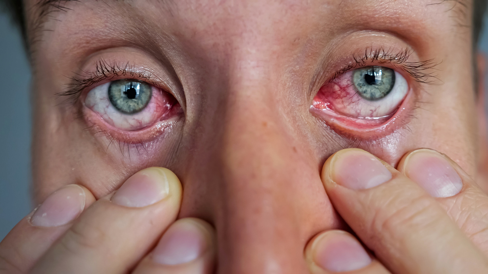 Então, o que é a síndrome do olho seco e por que ela é mais comum no inverno?