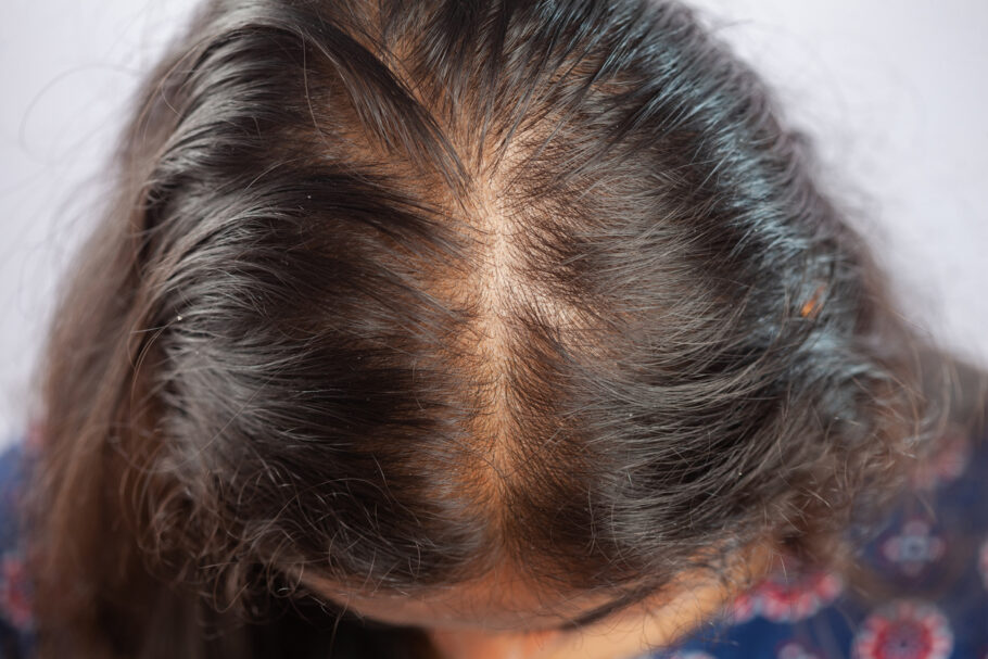 Alopecia androgenética é uma condição genética que faz cair cabelo