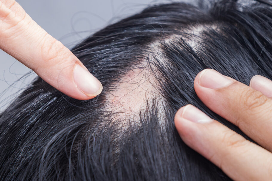 Alopecia areata é uma doença inflamatória que provoca a queda de cabelo