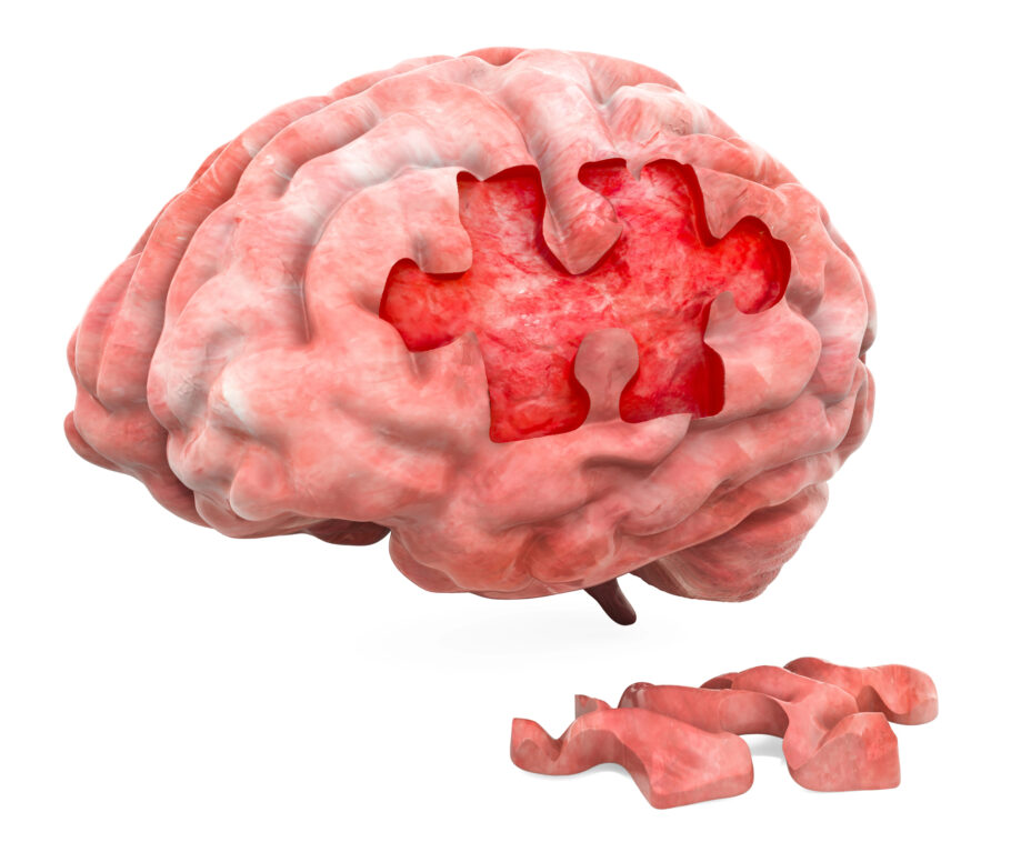 Estudo observa que pressão alta sem tratamento aumenta chances de uma pessoa ter Alzheimer