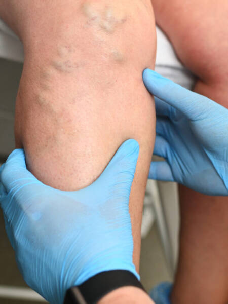 O cuidado com a circulação deve começar cedo, especialmente com uso de hormônios.