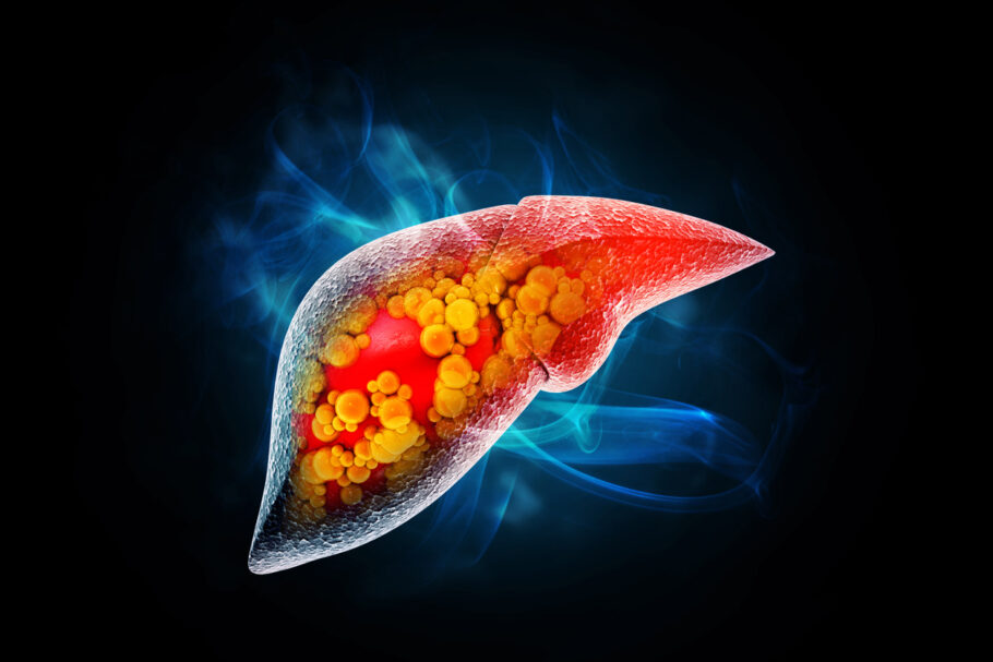 A esteatose hepática (gordura no fígado) pode passar completamente despercebida durante anos