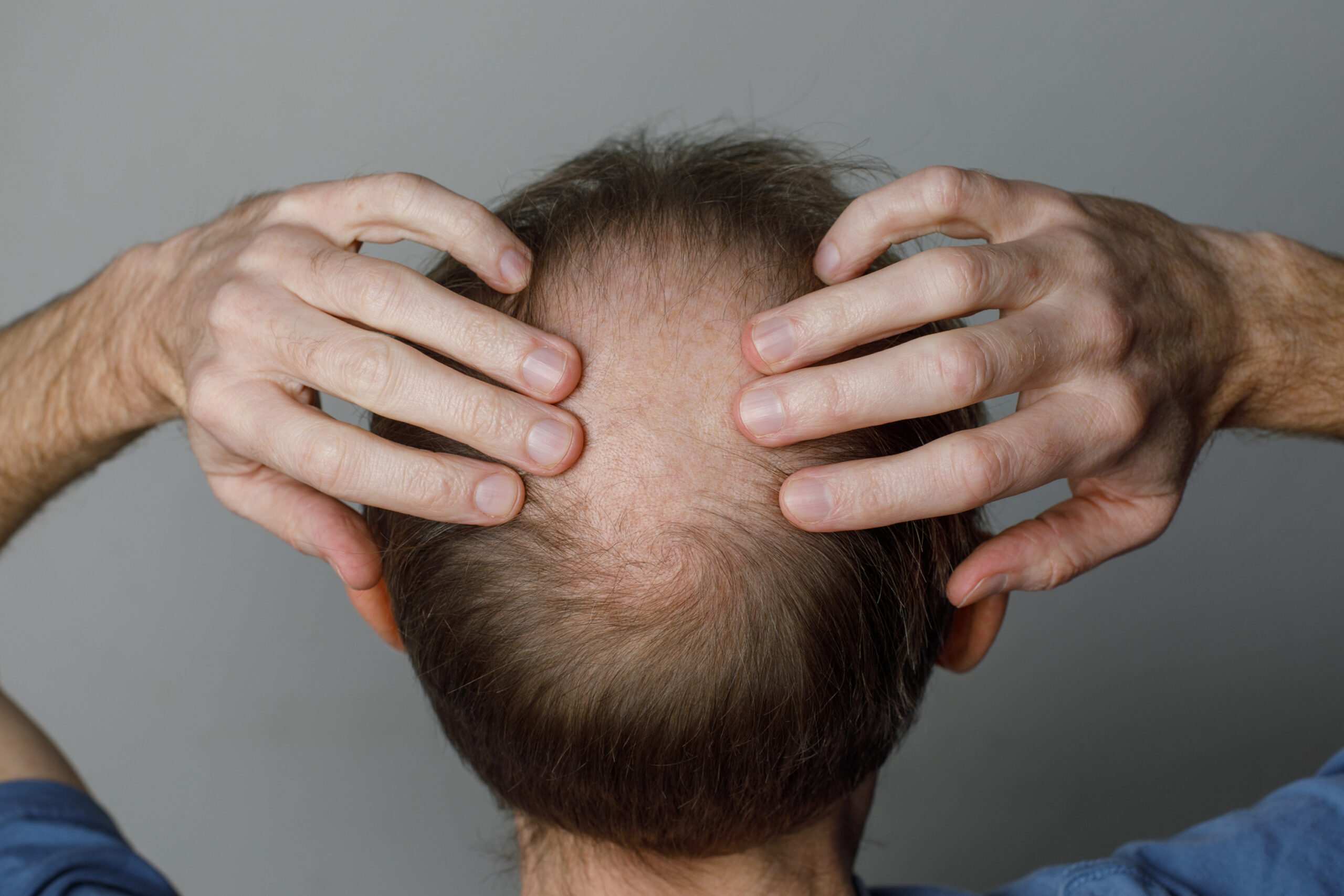 A bebida que pode aumentar o risco de queda de cabelo em homens