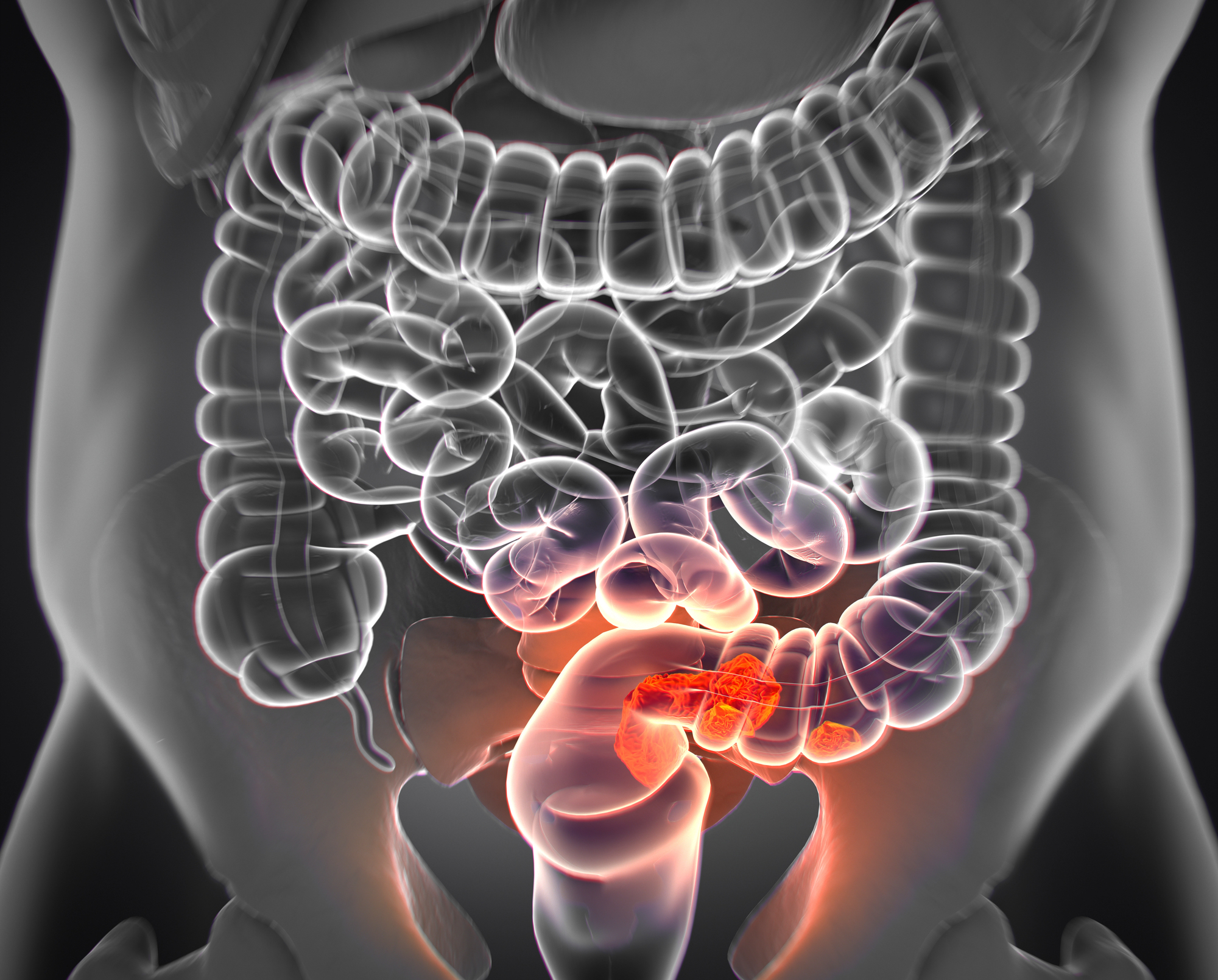 Vitamina reduz chances de você ter câncer no intestino