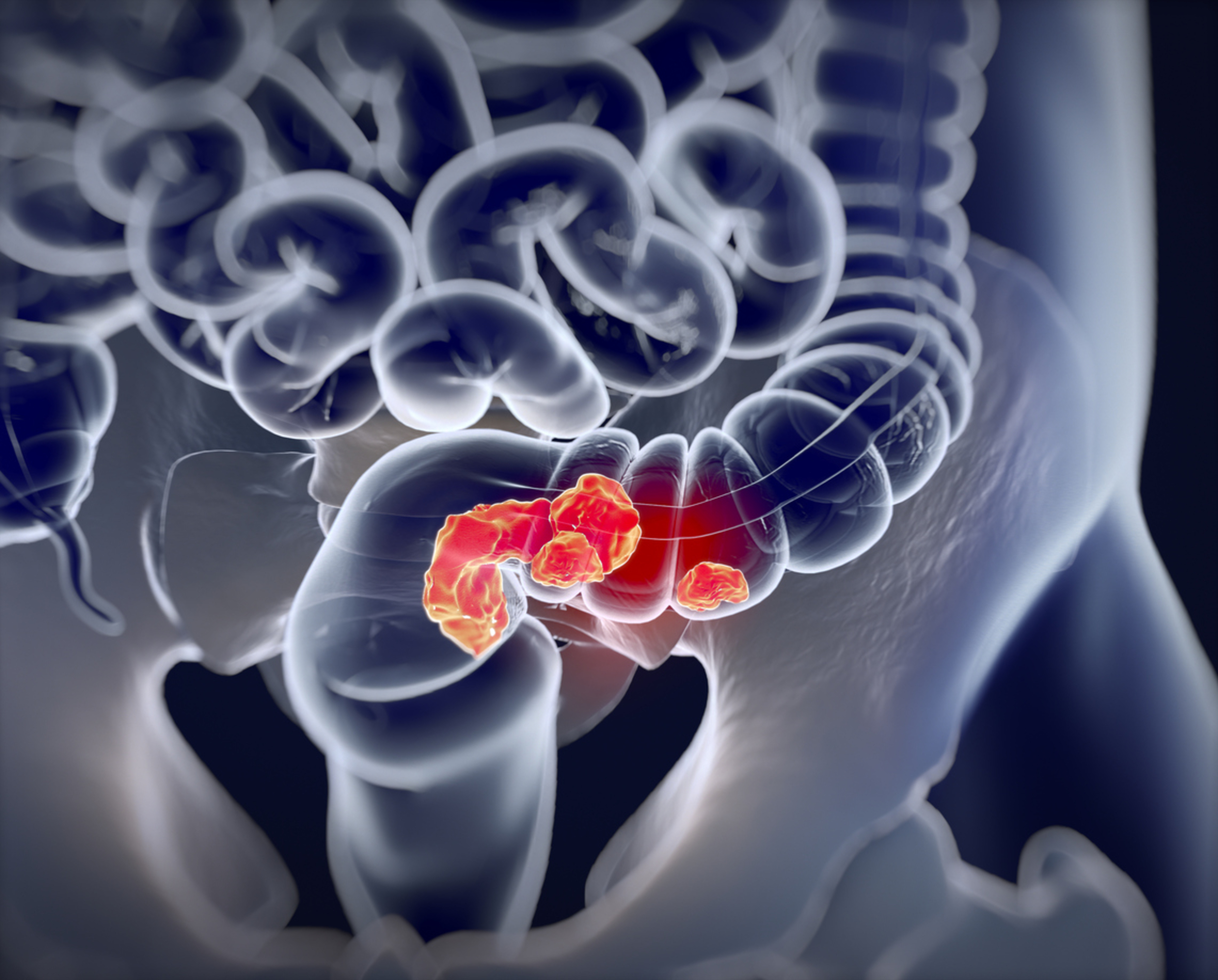 Alto consumo de alimentos ultraprocessados ​​aumenta o risco de câncer de intestino (colorretal)