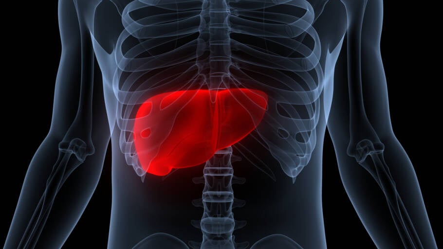 Gordura no fígado grau 3 é a forma mais grave da esteatose hepática pode causar inflamação, fibrose e até cirrose