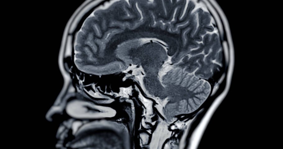 Um dos antidepressivos mais prescritos no mundo pode acelerar a perda de memória em pacientes com demência, segundo estudo