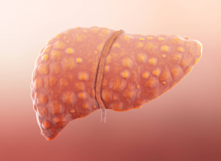 O excesso de gordura no fígado pode ser revertido com mudanças na alimentação e prática de exercícios físicos.